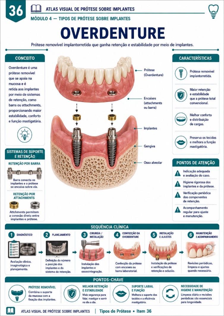 ATLAS visual sobre Overdenture